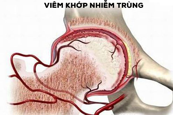 Biến chứng viêm khớp nhiễm trùng 